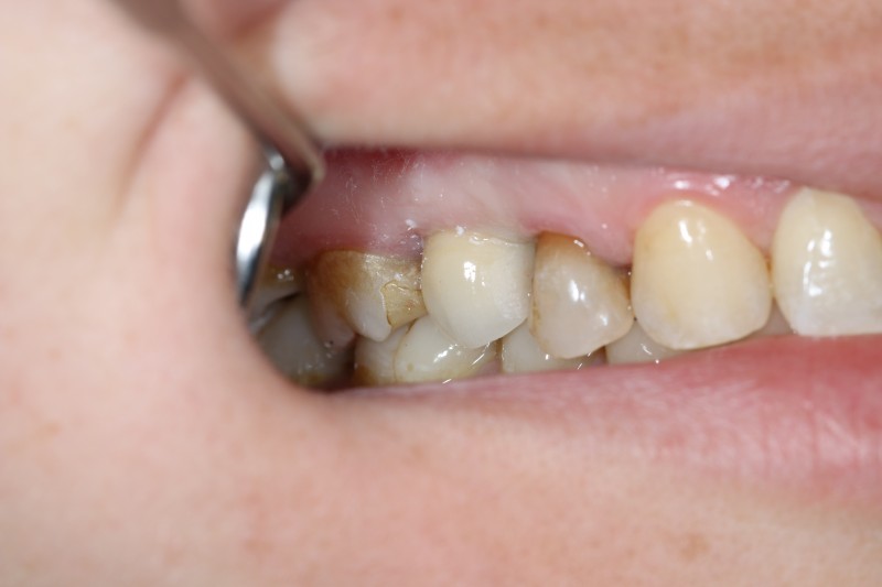 Natychmiastowa implantacja zęba